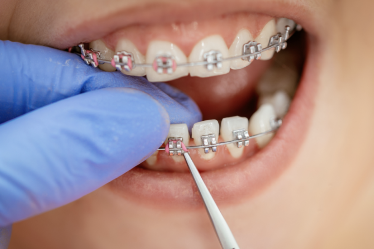 what to do if braces get loose or break