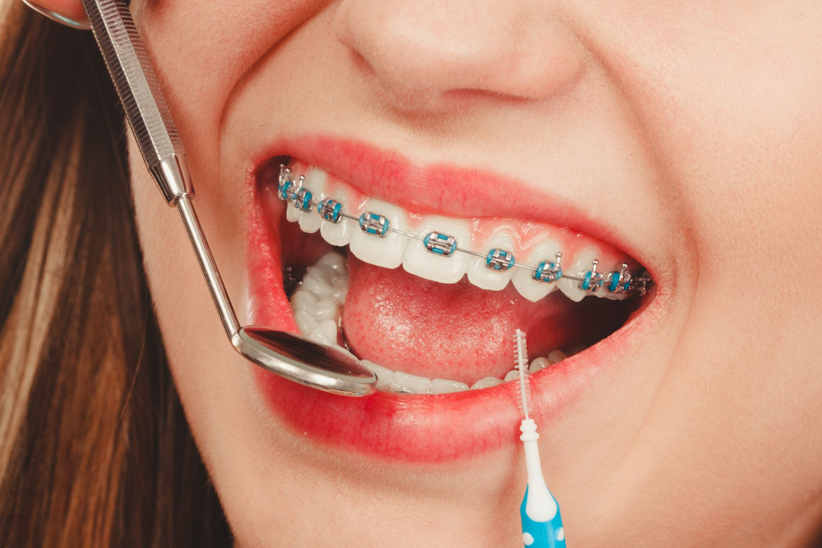 how long do you need to wear braces