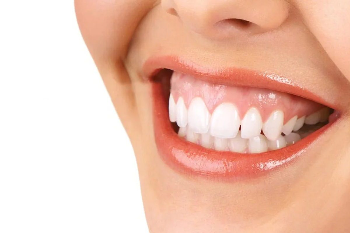 gummy smile correction techniques