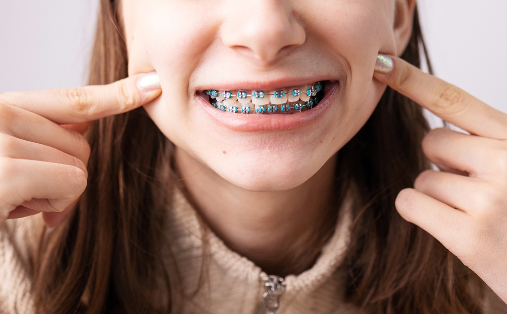 Braces and Facial Development: What Parents Should Know