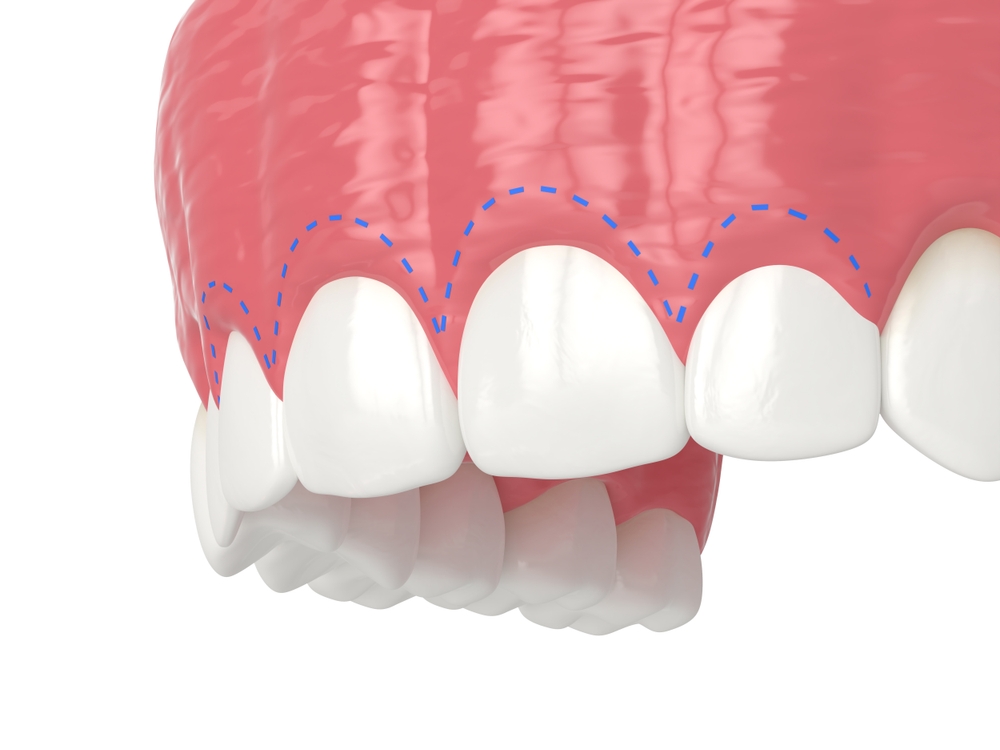 what is a gummy smile? and how is gummy smile treatment performed