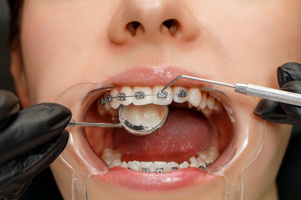 Managing Discomfort and Soreness After Braces Adjustments