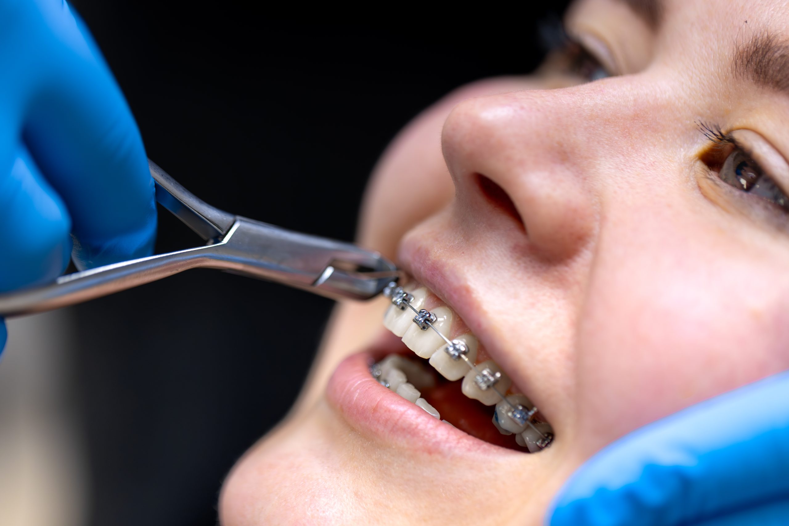how do you know if you need dental braces