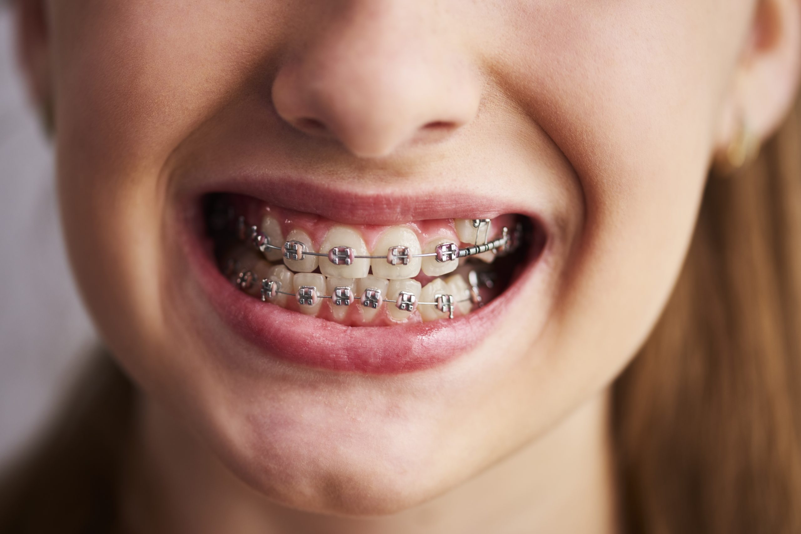 What Are the Different Types of Braces?
